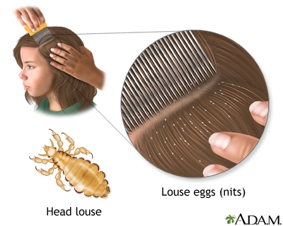 Head louse and louse eggs